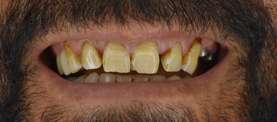 1 قبل از لیمنت و ایمپلمنت در دندان پزشکی اعلمی