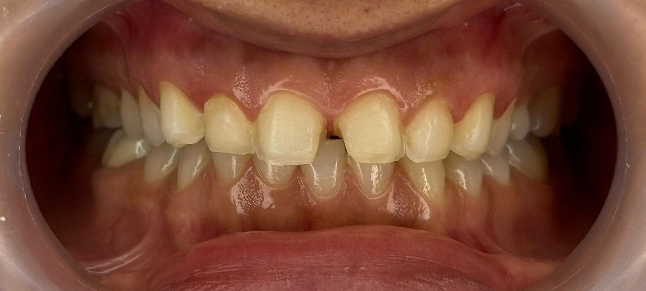 photo_2025-12-26_18-53-15 قبل از لیمنت در کلینک دندان اعلمی