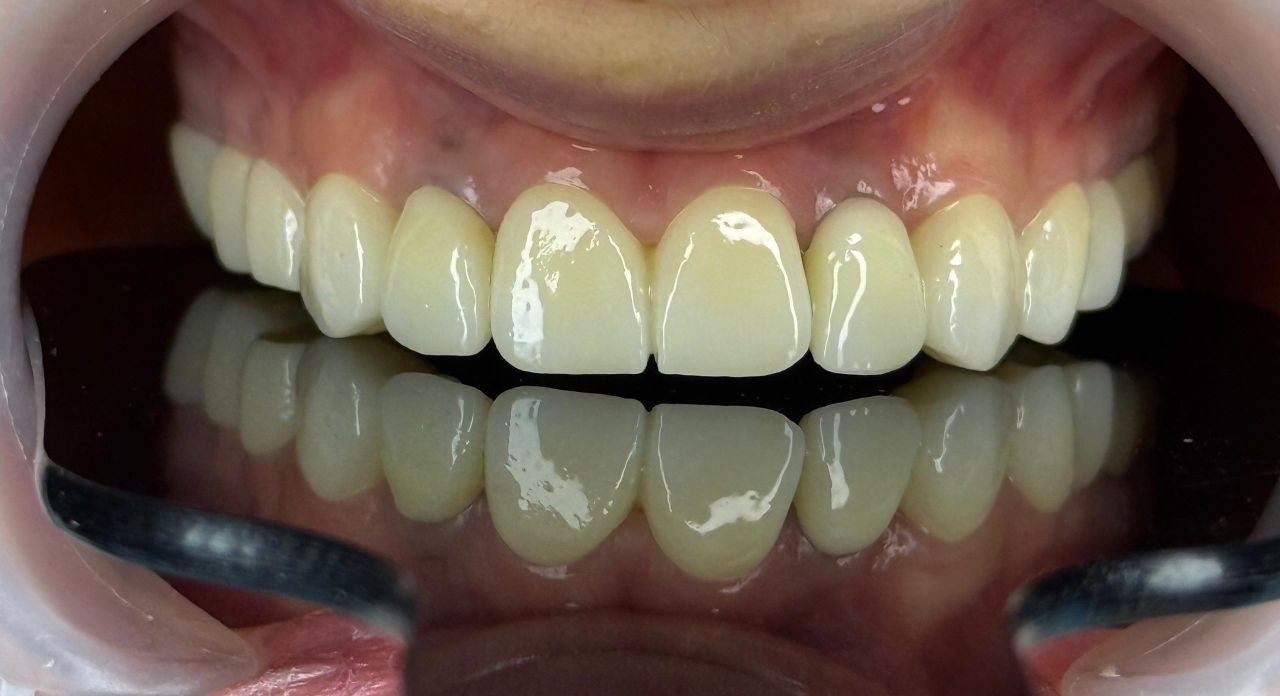 بعد از لیمنت در کلینک اعلمی