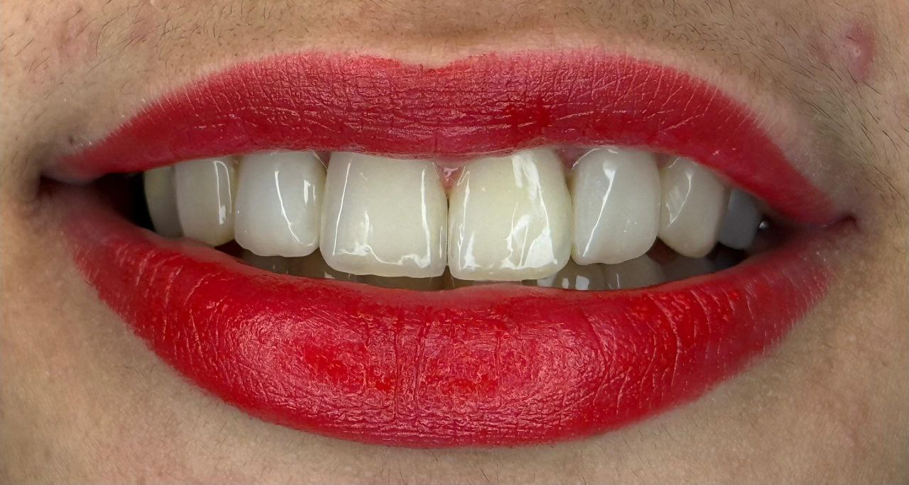 بعد از کامپوزیت ویینر در کلینیک اعلمی