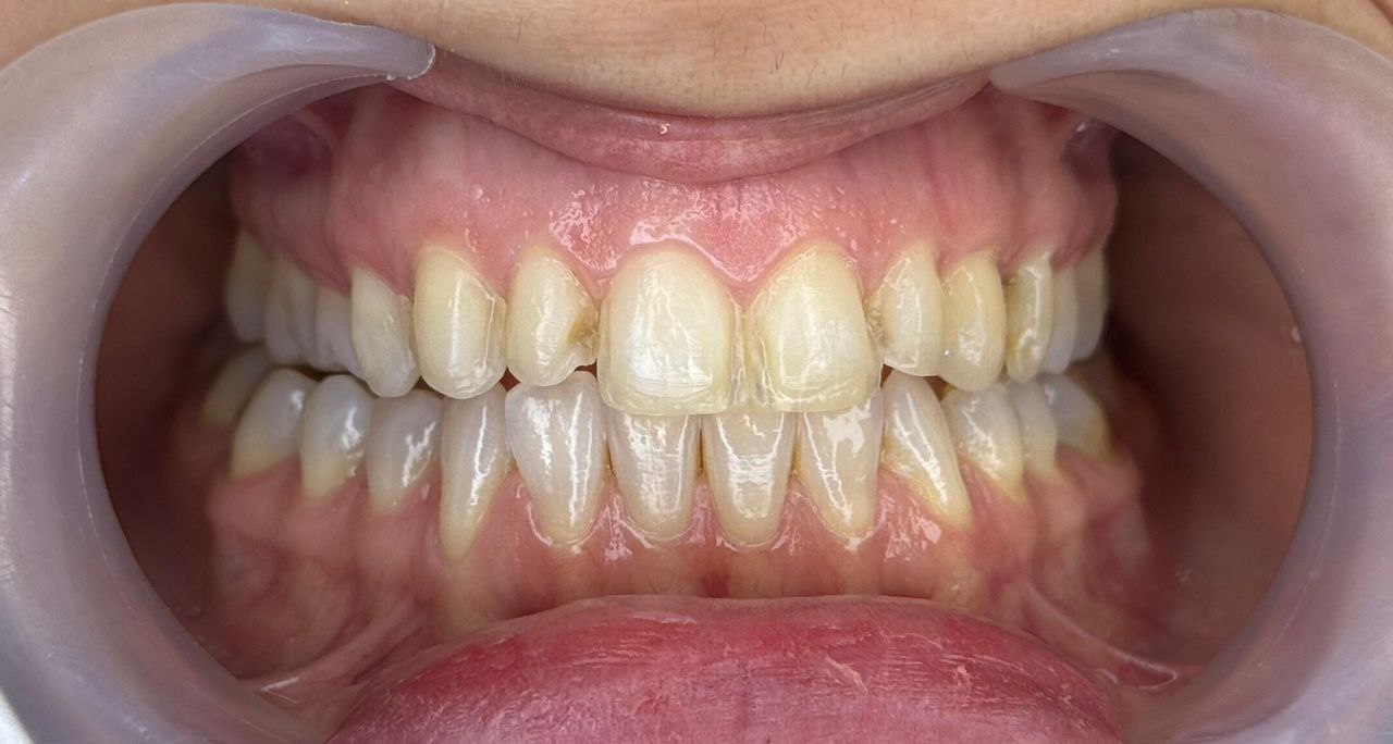 photo_2025-12-26_18-56-07 قبل از لیمنت در کلینیک اعلمی