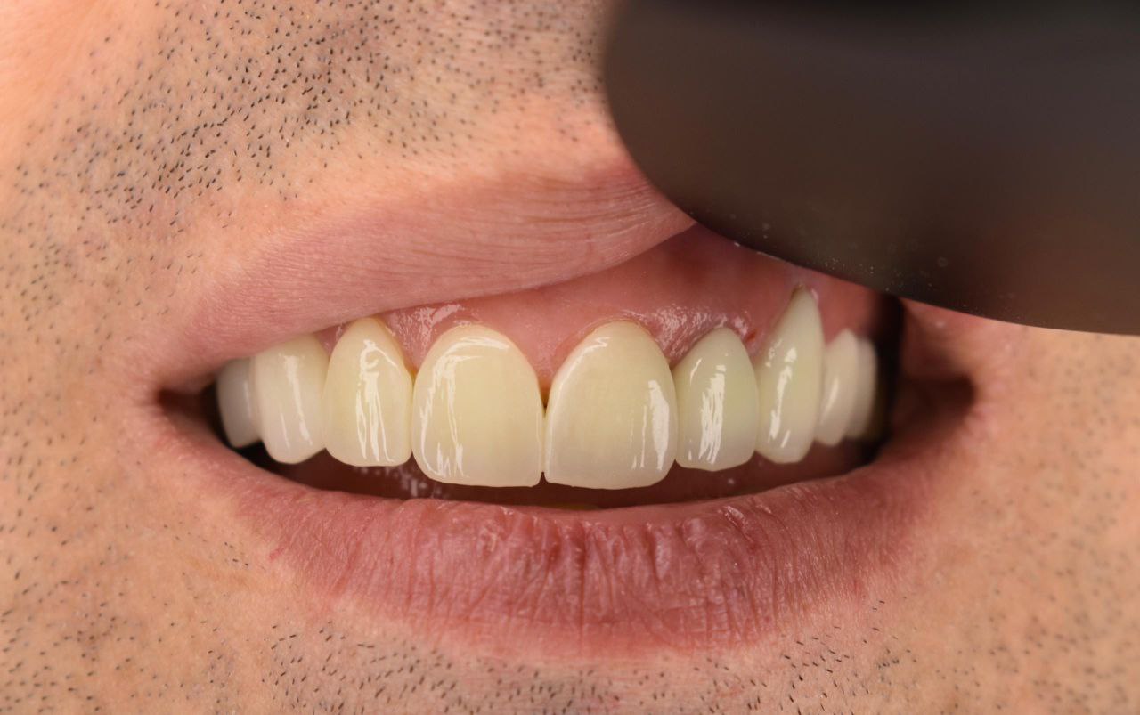 بعد از لیمنت در کلینیک اعلمی