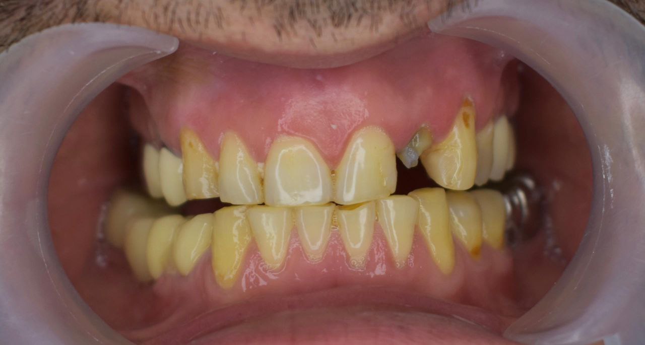 photo_2025-12-26_18-57-46 قبل از لیمنت در کلینیک اعلمی