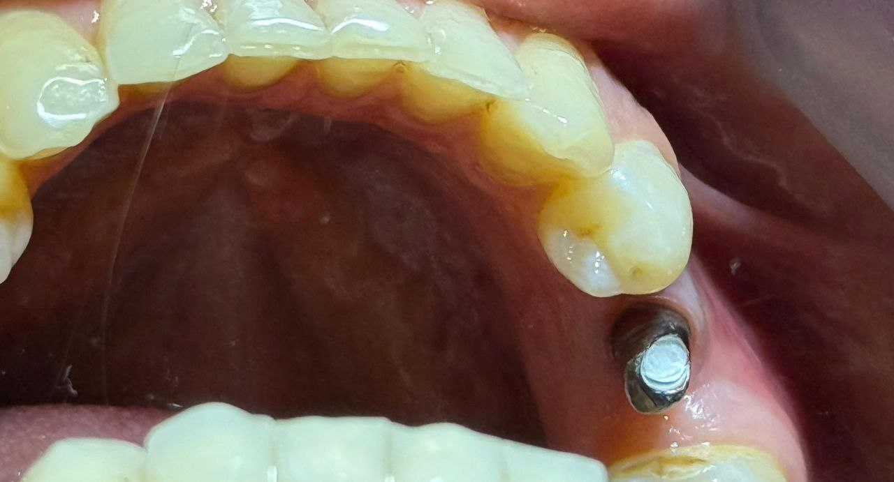 photo_2025-12-26_19-12-16 کاشت ایمپلنت در کلینیک اعلمی