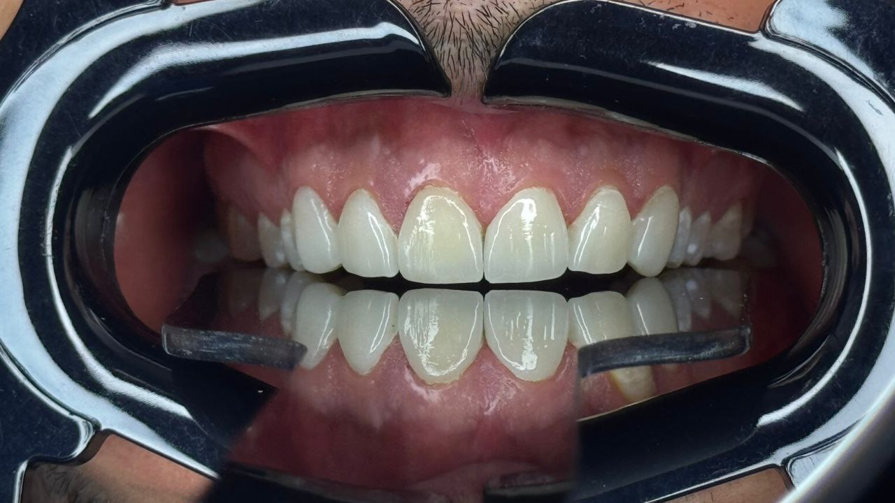 بعد از لیمنت در دندان پزشکی اعلمی