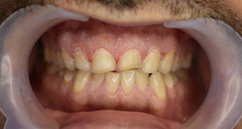 photo_2025-12-26_19-13-30 قبل از لیمنت در دندان پزشکی اعلمی