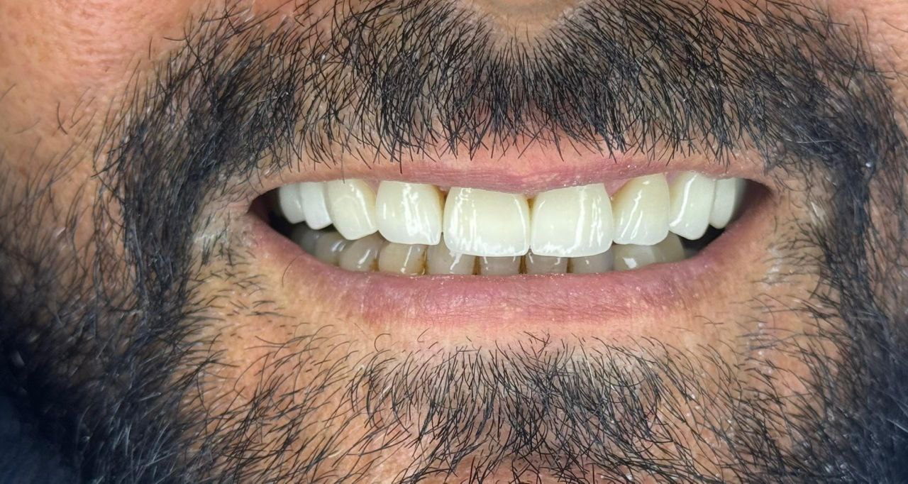 بعد از لیمنت و ایمپلمنت در دندان پزشکی اعلمی